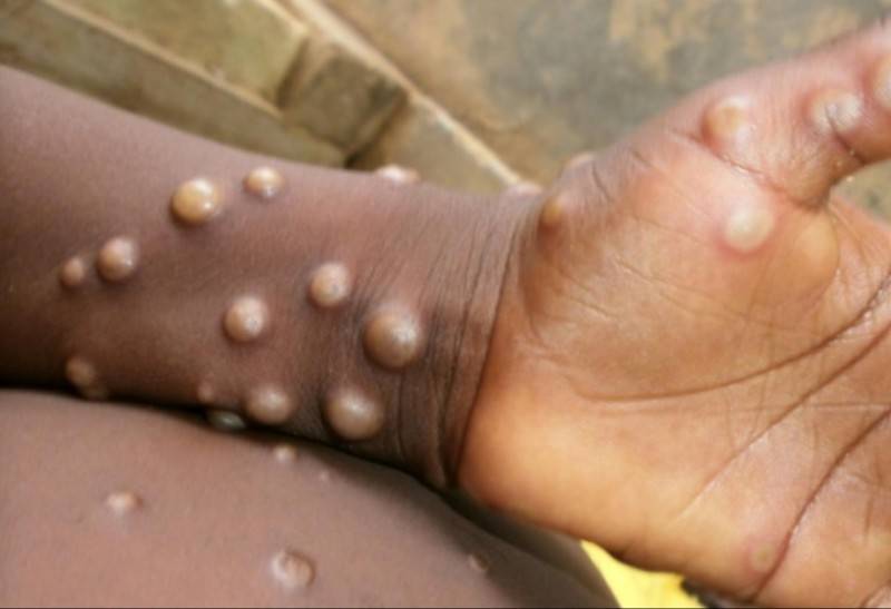 \"Meymunçiçəyi hələ bitməyib\" - ÜST