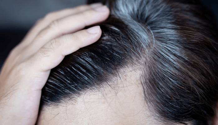 Saçların vaxtından əvvəl ağarmasının səbəbi bilindi