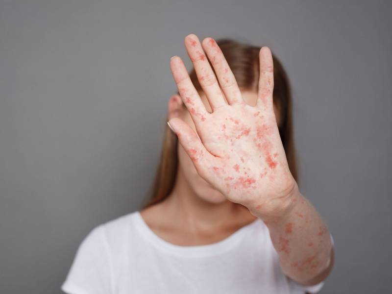 Qızılcadan ölən məktəbli ilə bağlı AÇIQLAMA