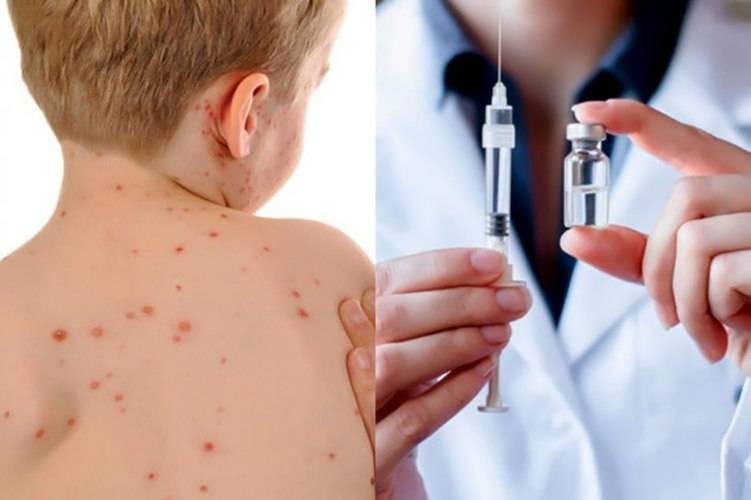 Kimlərin qızılcaya yoluxma riski daha çoxdur? - AÇIQLAMA