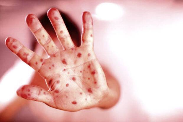 Azərbaycanda daha bir azyaşlı qızılcadan dünyasını dəyişdi