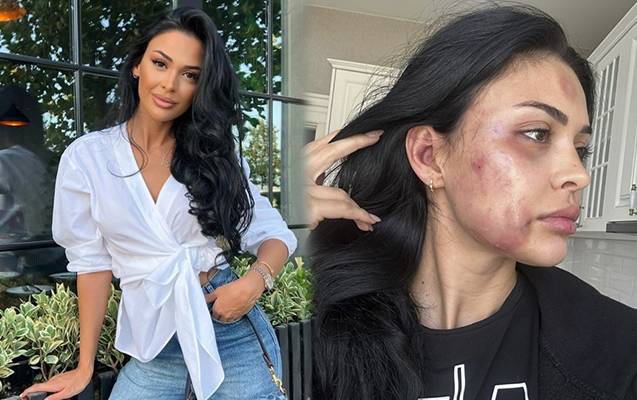 \"Modelin sevgilisi tərəfindən döyülməsi iddiaları araşdırılır\" - DİN-dən AÇIQLAMA