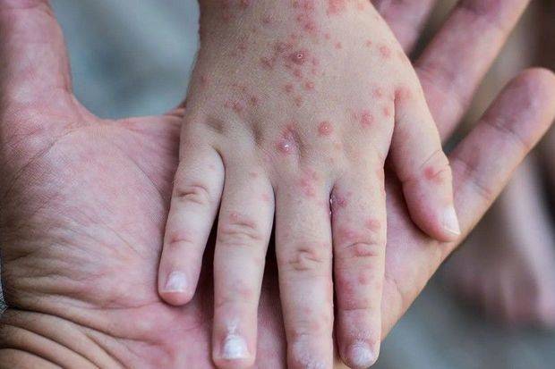 Naxçıvanda 6 nəfər qızılcaya yoluxdu