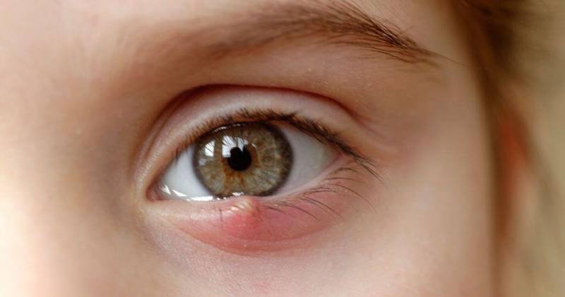 Gözdə “itdirsəyi” - Təhlükəlidir?