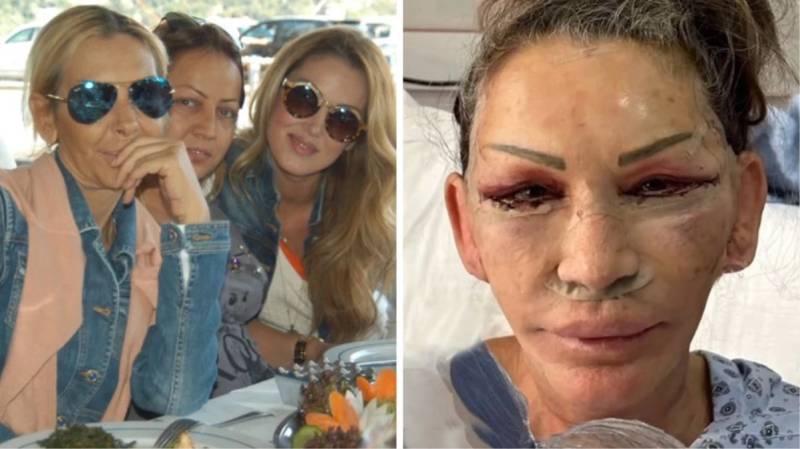 Məşhur müğənninin anası plastik əməliyyat keçirdi - FOTO