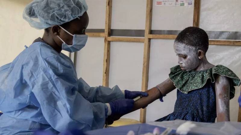 Avropa İttifaqı meymunçiçəyinə qarşı vaksinasiyanı rədd edir