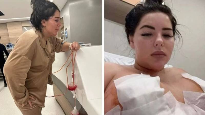 Estetik əməliyyat etdirən modelin bədəni çürüməyə başladı - FOTO