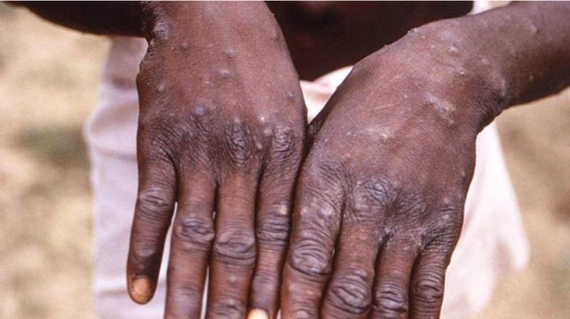 Bu ölkədə təhlükəli virus yayılıb - Çox sayda ölən var