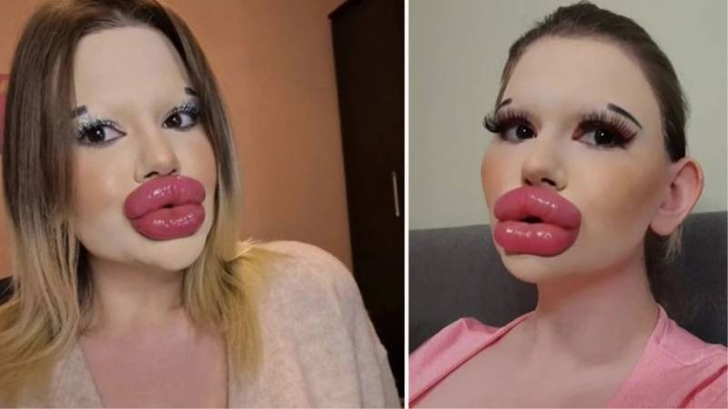 Dünyanın ən böyük dodaqlı qadınının yeni hədəfi ölümünə səbəb ola bilər