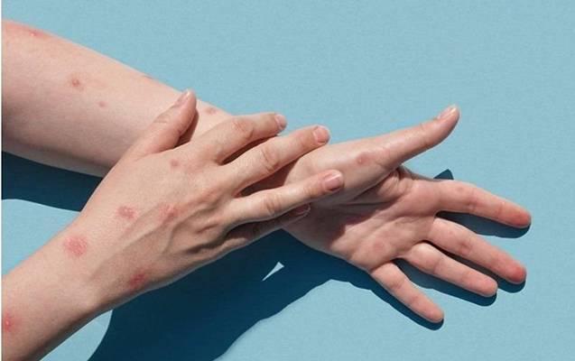 Bu ölkədə \"Meymun çiçəyi\"ndən ölənlərin sayı 1100-ə çatdı