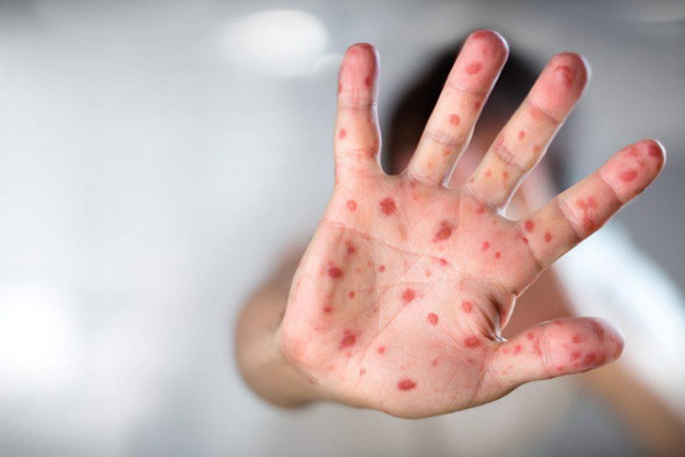 Qızılca epidemiyası yayılır -&nbsp;Xəstə sayı 1000-ə yaxınlaşır