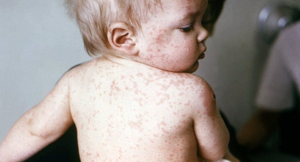 Uşaqlar arasında suçiçəyi xəstəliyi yayılıb - VİDEO