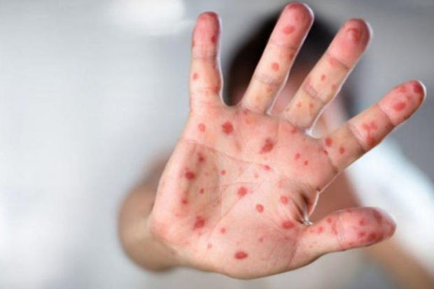 Londonda xəstəlik yayılıb