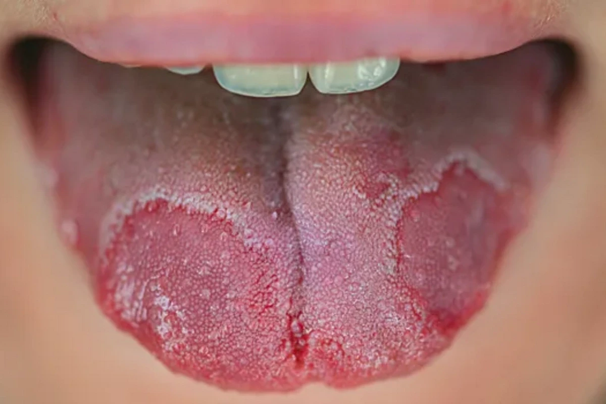 Dil üzərindəki ləkələr bu xəstəliyin ƏLAMƏTİDİR