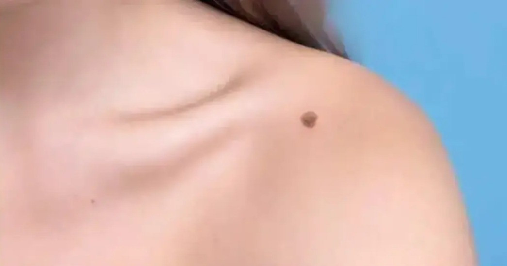 Dəri törəmələri hansı xəstəliklərin xəbərçisi ola bilər?