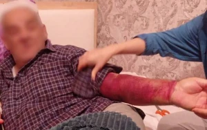 ““Medical Plaza”da 4500 AZN alıb qan köçürdülər - Qolu bu vəziyyətə düşdü”