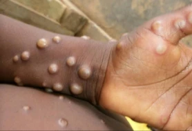 \"Meymunçiçəyi hələ bitməyib\" - ÜST