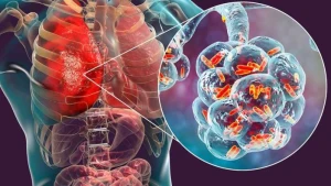 Polşada legionella bakteriyası xəbərdarlığı: 7 nəfər öldü