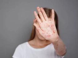 Qızılcadan ölən məktəbli ilə bağlı AÇIQLAMA