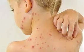 Daha bir rayonda qızılca aşkarlandı