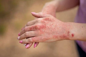 Azərbaycanda qızılca ilə bağlı son vəziyyət AÇIQLANDI