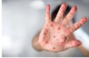 Bu rayonda  qızılcaya yoluxanların sayı ARTDI