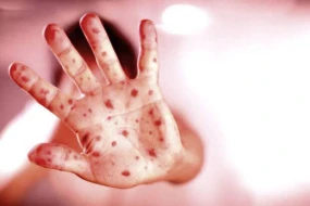 Azərbaycanda daha bir azyaşlı qızılcadan dünyasını dəyişdi