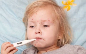 Qızılcaya yoluxmada kəskin artım var - ÜST