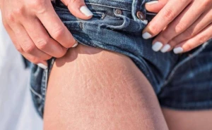 3 məhsulla selulitə son! 