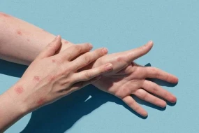 Meymunçiçəyi ən çox hansı ölkələrdə yayılıb? - ÜST açıqladı