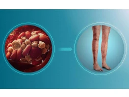 \"Yapışqan\" qan xəstəliyi - Çox həkimlər bilmir