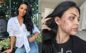 \"Modelin sevgilisi tərəfindən döyülməsi iddiaları araşdırılır\" - DİN-dən AÇIQLAMA