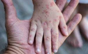 Zaqatalada qızılcaya yoluxanların son durumu AÇIQLANDI