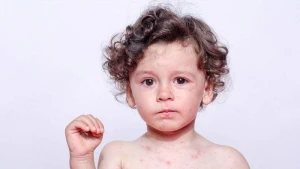 Məktəblərdə qızılcaya qarşı hansı tədbirlər görülür? - Nazirlikdən açıqlama