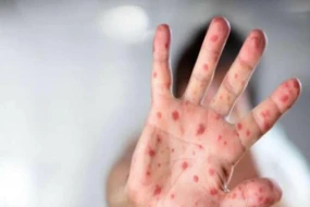 Bakıda qızılcaya görə heç bir məktəb bağlanmayıb - RƏSMİ