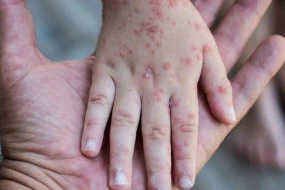 Naxçıvanda 6 nəfər qızılcaya yoluxdu