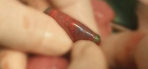 Mingəçevirdə yad cisim udan azyaşlının həyatı xilas olundu