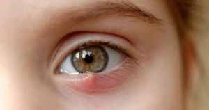 Gözdə “itdirsəyi” - Təhlükəlidir?
