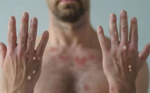 Bu ölkədə meymunçiçəyi xəstəliyinə görə nəzarət gücləndirildi 