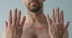 Bu il meymunçiçəyindən neçə nəfər ölüb? 