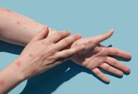 Meymunçiçəyinə yoluxanların sayı 23 minə çatdı