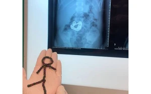 Bakıda 4 yaşlı uşaq 53 maqnit udub - FOTO