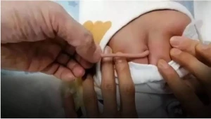 Bu ölkədə quyruqlu körpə dünyaya gəldi