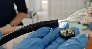 Həkimlər 5 yaşlı qızın mədəsindən maqnit çıxartdılar