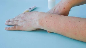 Türkiyədə meymun çiçəyi şübhəsi - VİDEO