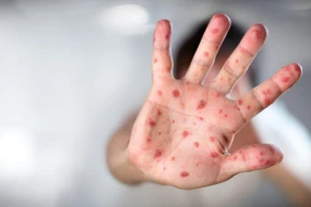 Qızılca epidemiyası yayılır -&nbsp;Xəstə sayı 1000-ə yaxınlaşır