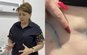 Daha bir “plastik cərrah” qalmaqalı: “Bədənim çürüyür” - VİDEO