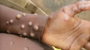 Bu ölkədə \"M pox\" virusundan ilk ölüm qeydə alındı