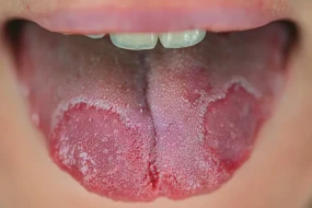 Dil üzərindəki ləkələr bu xəstəliyin ƏLAMƏTİDİR