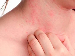 Yayda səpkilərdən necə qurtulmaq olar? - Dermatoloqdan tövsiyə